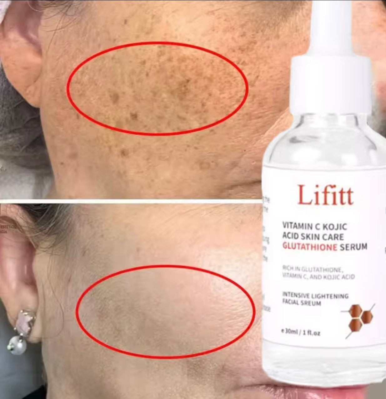 Lifitt blackhead and pimples absorber